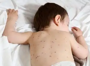Tips Mengobati Cacar Air pada Anak