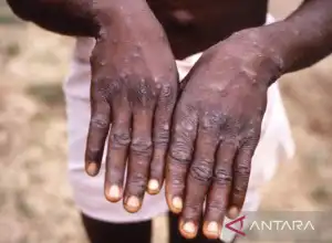 Seorang Pria di Nigeria Meninggal Dunia Akibat Cacar Monyet