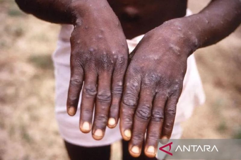 WHO Ubah Nama Cacar Monyet Jadi "mpox", Ini Penjelasannya